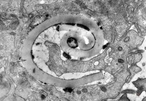 M,43y. | blood - degraded Candida (bone marrow suppression)